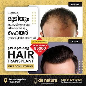 Hair transplantation